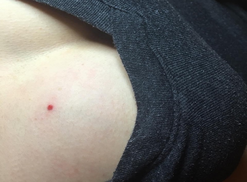 Nốt ruồi phú quý may mắn - Nốt ruồi có quý nhân phù trợ 3 Nốt ruồi mang lại may mắn nằm ở ngực