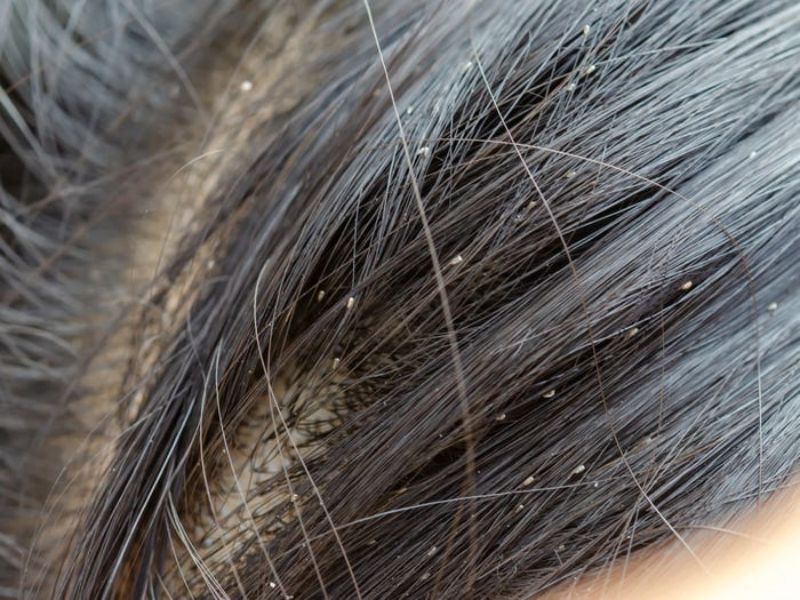 Mơ thấy con chấy đánh con gì? Mơ thấy chấy rận trên đầu 1 Mơ thấy con chấy đánh con gì bao ăn?